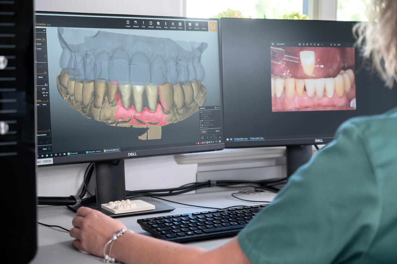 Kronen im Frontzahnbereich