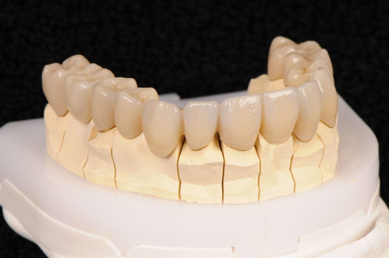 Teleskopprothese auf galvano Käppchen