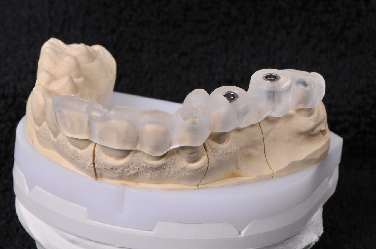 Bohrschablone für das setzen von Implantaten, hergestellt im digitalen Workflow