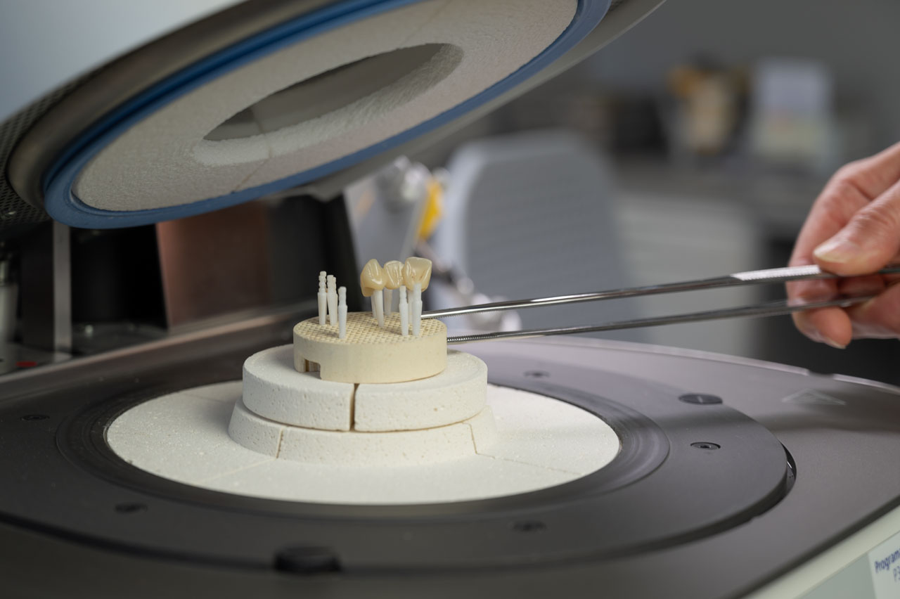 Kronen im Frontzahnbereich