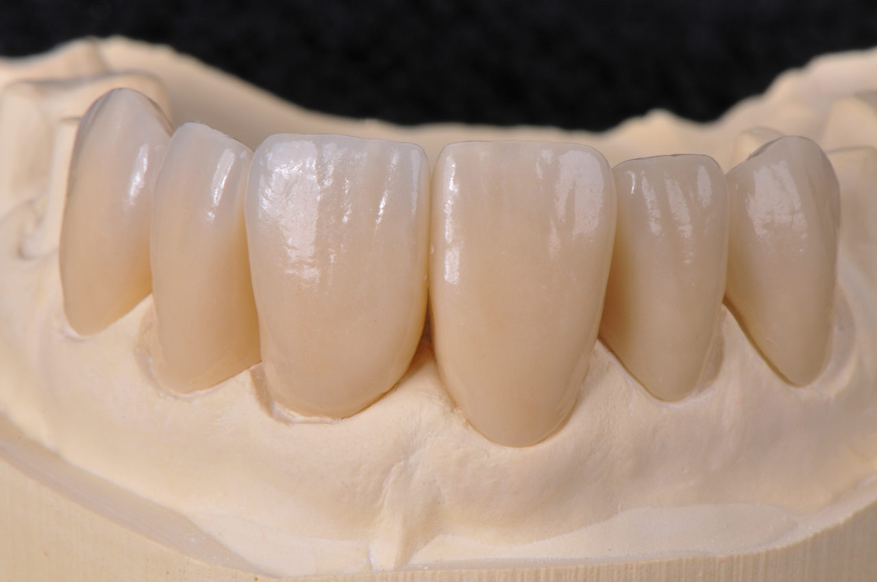 Kronen im Frontzahnbereich