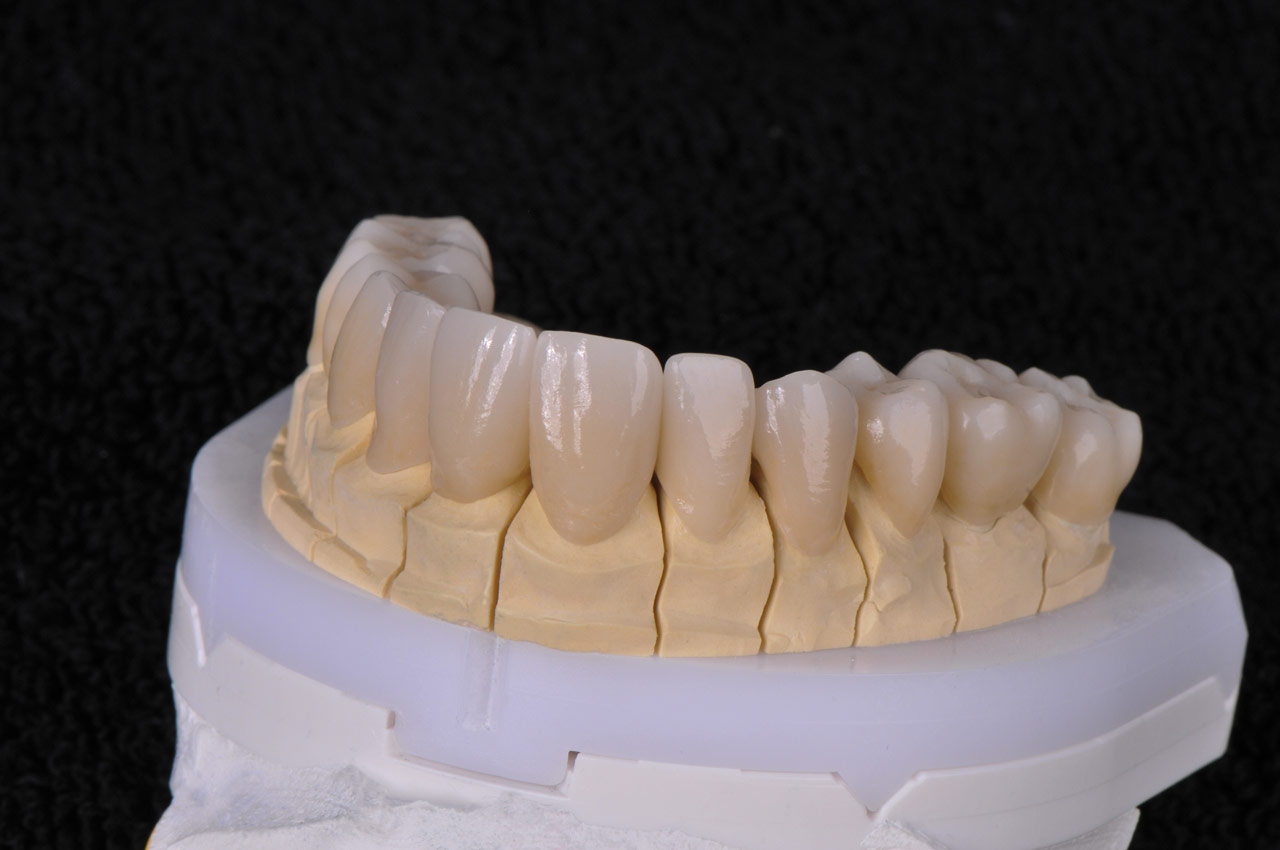 Kronen des gesamten Oberkiefers auf Modell