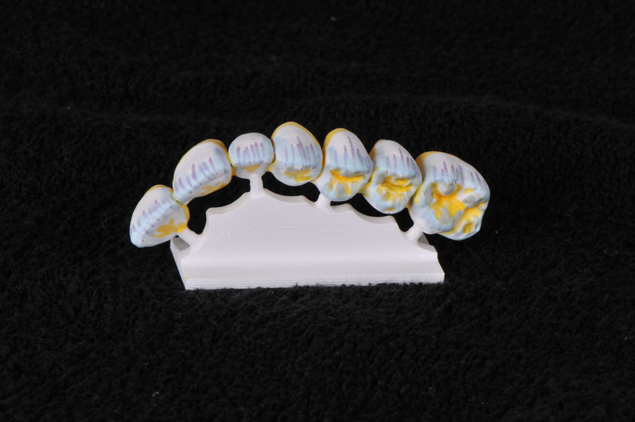 Zirkonbrücke fertig bemalt vor dem Sinterprozess