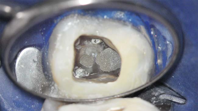 Zahn verfärbt sich grau nach wurzelbehandlung